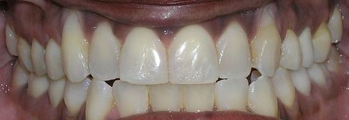A close up of a person 's teeth with a few holes in them.