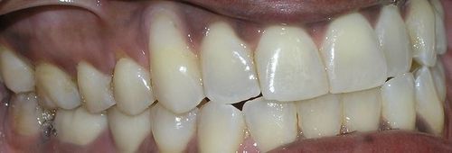 A close up of a person 's teeth with a broken tooth.