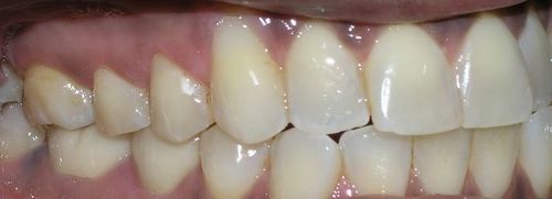 A close up of a person 's teeth and gums.