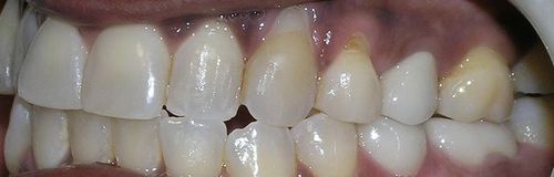 A close up of a person 's teeth with a hole in the middle.