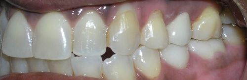 A close up of a person 's teeth with a broken tooth.