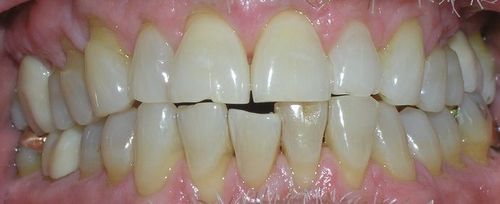 A close up of a person 's teeth with a broken tooth.