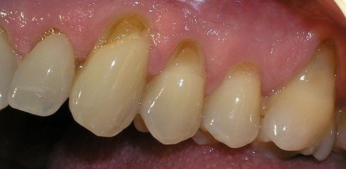 A close up of a person 's teeth and gums.