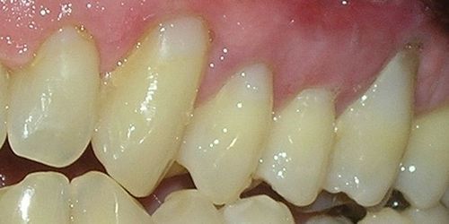 A close up of a person 's teeth and gums.
