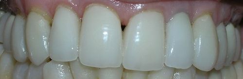 A close up of a person 's teeth with white teeth.