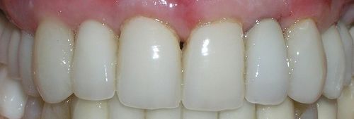A close up of a person 's teeth with white teeth.