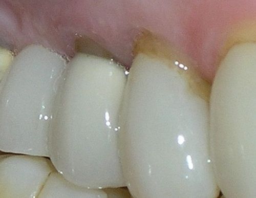 A close up of a person 's teeth with a toothache.