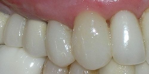A close up of a person 's teeth and gums.