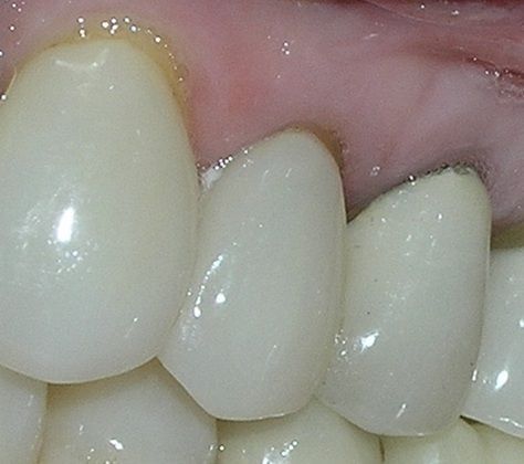 A close up of a person 's teeth with a tooth missing