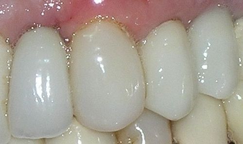 A close up of a person 's teeth with a red gums.