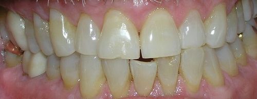 A close up of a person 's teeth with a broken tooth.