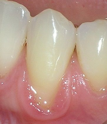 A close up of a person 's teeth with a pink gums