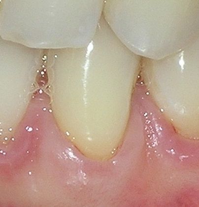 A close up of a person 's teeth and gums