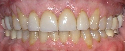 A close up of a person 's teeth with white teeth.