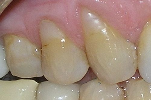 A close up of a person 's teeth with a pink gums.