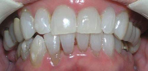 A close up of a person 's teeth with white teeth.