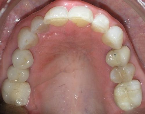 A close up of a person 's mouth with a lot of teeth.