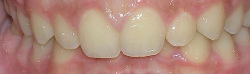 A close up of a person 's teeth and gums.