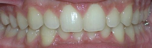 A close up of a person 's teeth with white teeth.