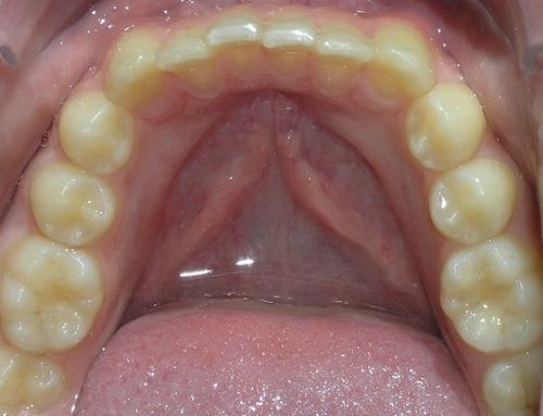 A close up of a person 's teeth with their tongue sticking out.