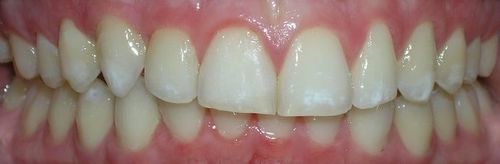 A close up of a person 's teeth with white teeth and red gums.