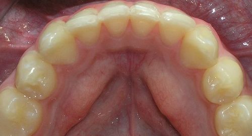 A close up of a person 's teeth in their mouth.