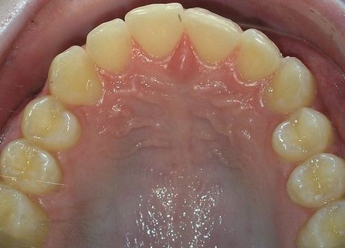 A close up of a person 's teeth and mouth.