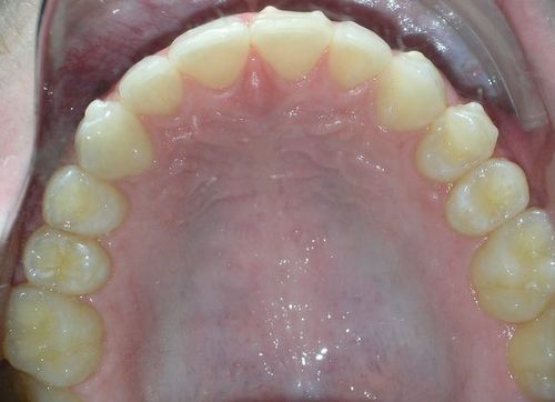 A close up of a person 's teeth and mouth.