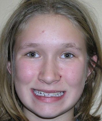 A young girl with braces on her teeth is smiling for the camera.