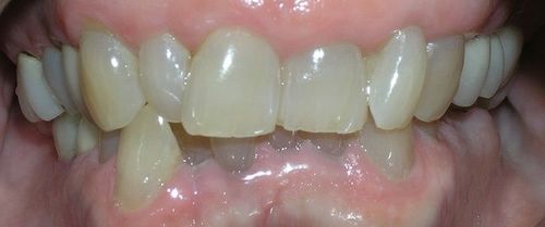 A close up of a person 's teeth with a broken tooth.