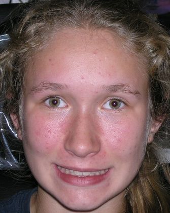A young girl with red spots on her face is smiling.