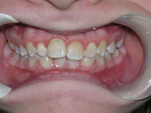 A close up of a person 's teeth with a mouth guard.