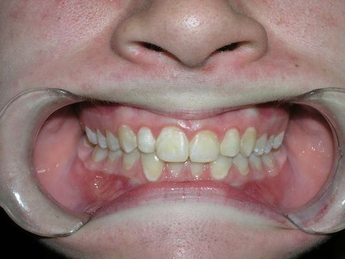 A close up of a person 's mouth with a mouth guard.