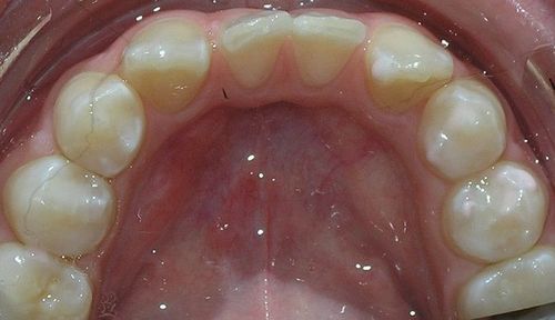 A close up of a person 's teeth and mouth.