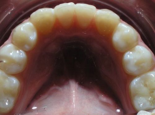 A close up of a person 's teeth with a tooth missing.