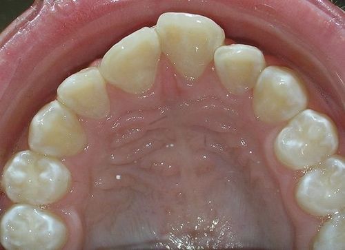 A close up of a person 's teeth with a lot of white teeth.
