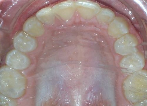 A close up of a person 's teeth and mouth.