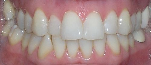 A close up of a person 's teeth with white teeth.