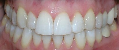 A close up of a person 's teeth with white teeth.