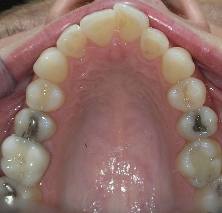 A close up of a person 's mouth with a lot of teeth