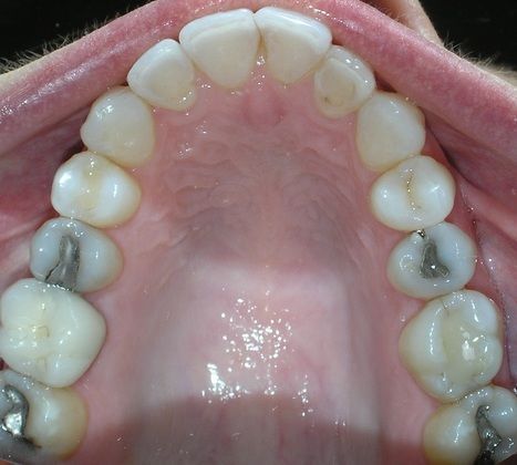 A close up of a person 's teeth with a few missing