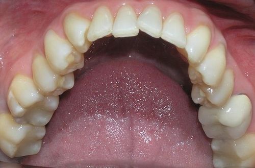A close up of a person 's teeth and tongue.