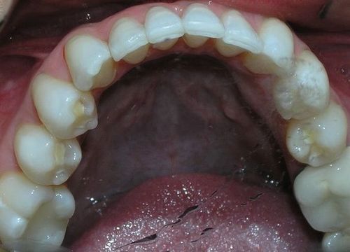 A close up of a person 's teeth with a tongue sticking out.