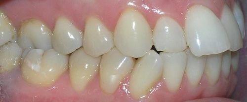 A close up of a person 's teeth with a broken tooth.