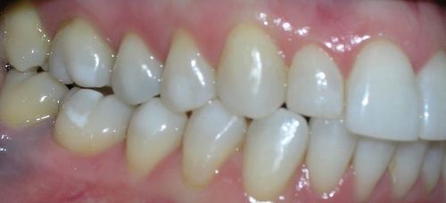 A close up of a person 's teeth with white teeth.