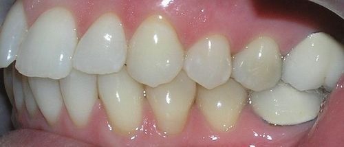 A close up of a person 's teeth and gums.