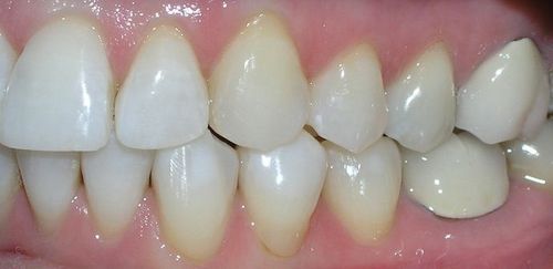 A close up of a person 's teeth with a broken tooth.