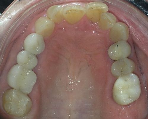 A close up of a person 's mouth with a lot of teeth.