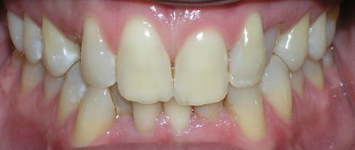 A close up of a person 's teeth and gums.