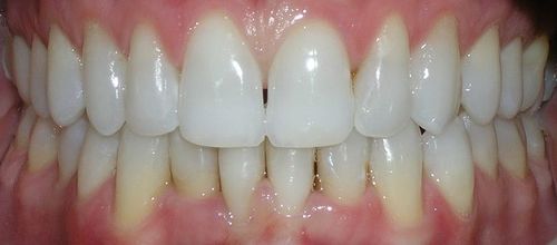 A close up of a person 's teeth with white teeth.